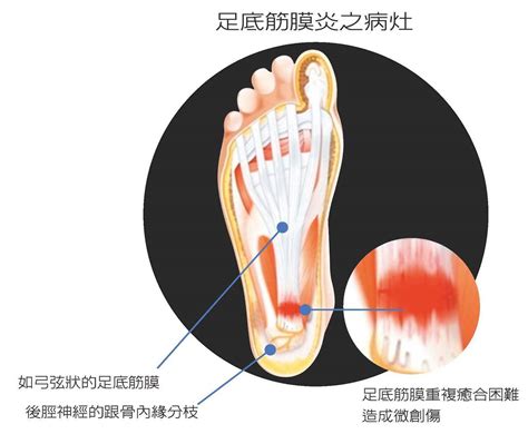 打腳板|腳底痛都是足底筋膜炎嗎？圖解腳底板痛的可能病症